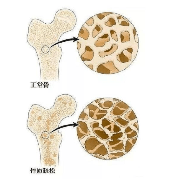 世界骨质疏松日 间充质干细胞与骨质疏松_手机搜狐网