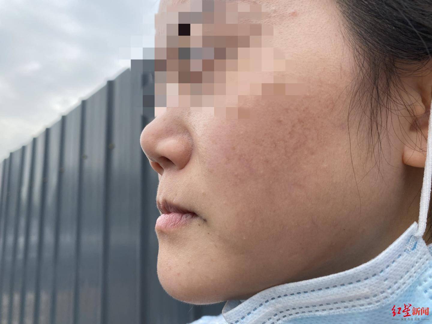 恒达官网整形悲剧:“成都赵丽颖”没当成,鼻子还变形 院方:手术确实出了问题 (图2) 恒达官网整形悲剧:“成都赵丽颖”没当成,鼻子还变形 院方:手术确实出了问题 (图2)