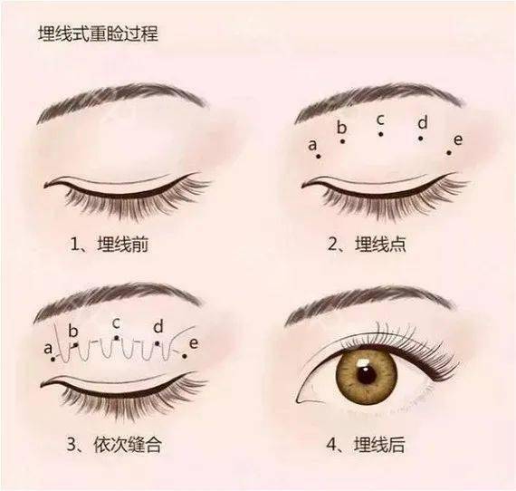 双杠|“悲伤蛙”，双杠眼……双眼皮到底怎么割？！