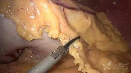 高清图解腹腔镜胰十二指肠切除术(多图预警)