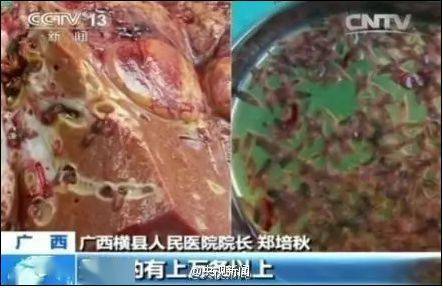 肝片形吸虫和姜片吸虫_中国患肝一般能活几年_吃生鱼片患肝吸虫病
