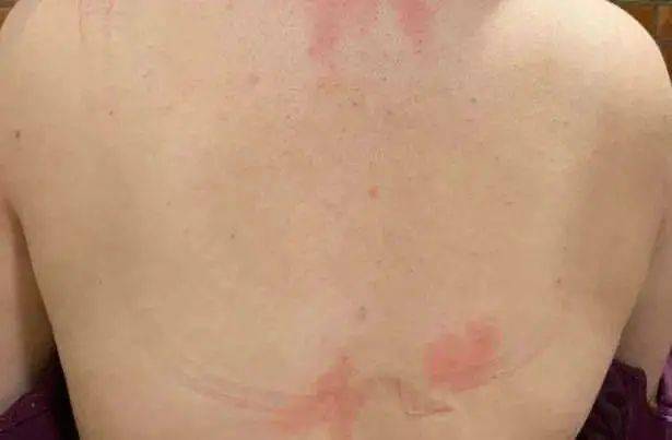 胸部|胸部自然生长到 34J，被逼众筹缩胸，胸大的烦恼她知道