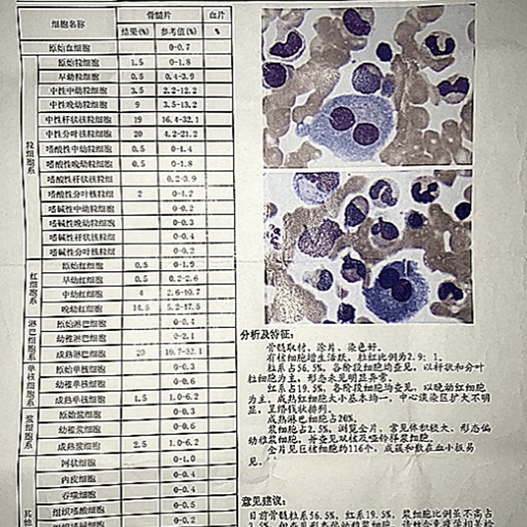 5%,常见体积较大,形态偏幼稚浆细胞,并查见双核及哑铃样浆细胞.