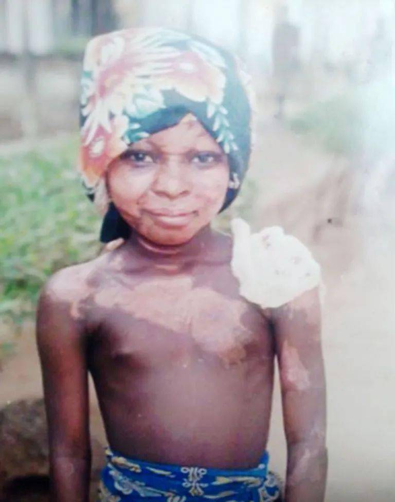 女童|非洲部落9岁毁容女童接受“换头术”，15年后现状曝光看哭网友：这才是顶级美人！