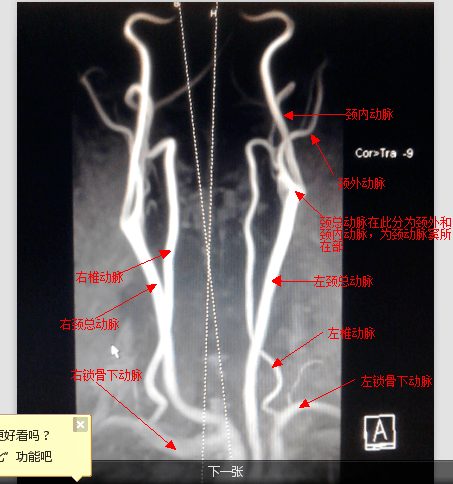 解剖颅内血管丨轻松看懂脑血管造影