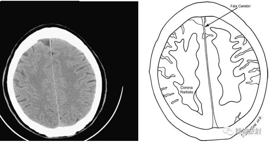 颅脑ct的正常解剖_大脑