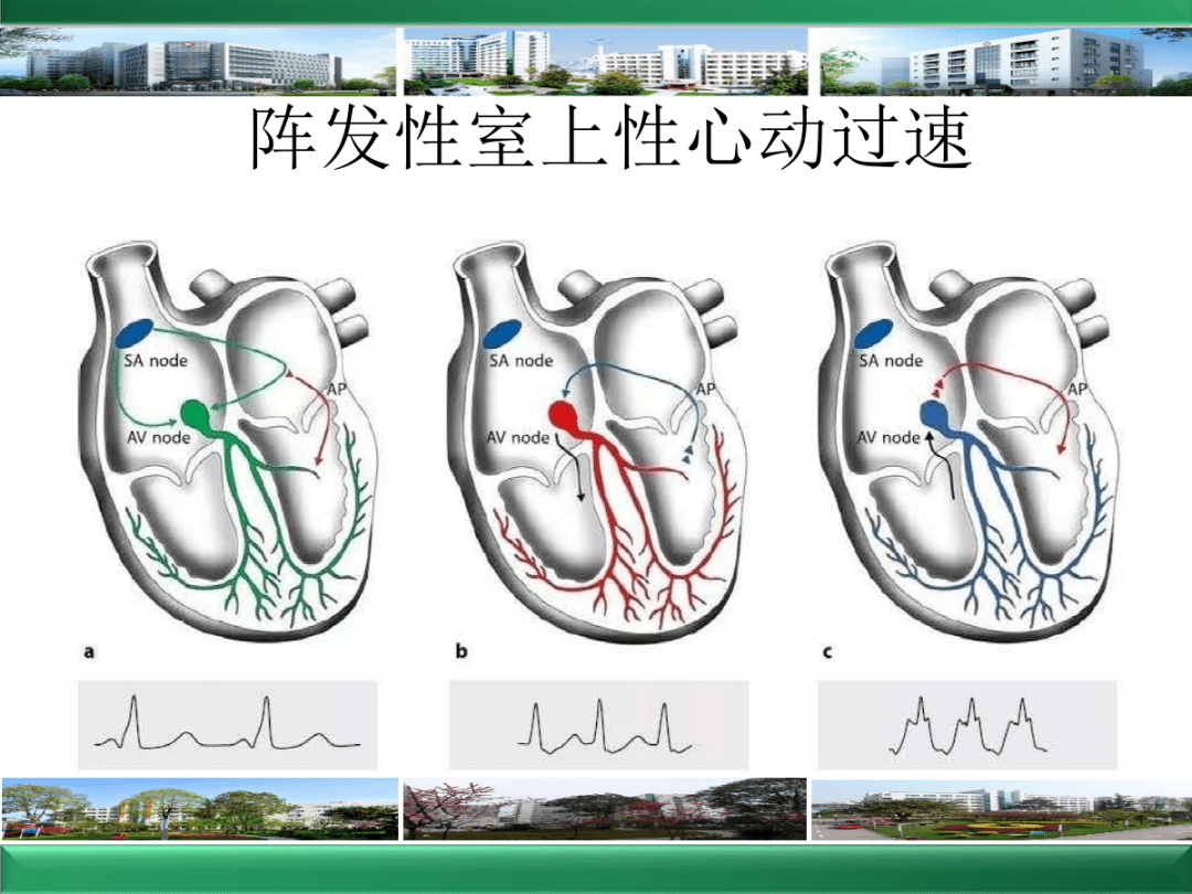 室上速应用改良valsalva动作的体会