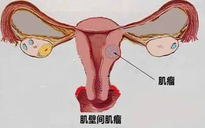 8点几公分的子宫肌瘤可以不用手术吗