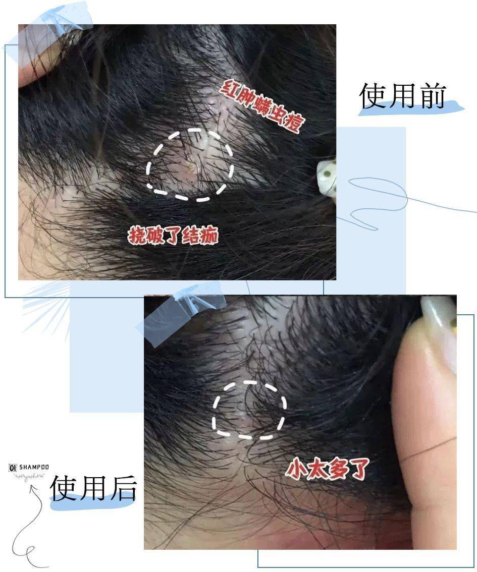 克兰|头上抠下的“白泥”，居然不是头皮屑？脱发头油都是因为它？
