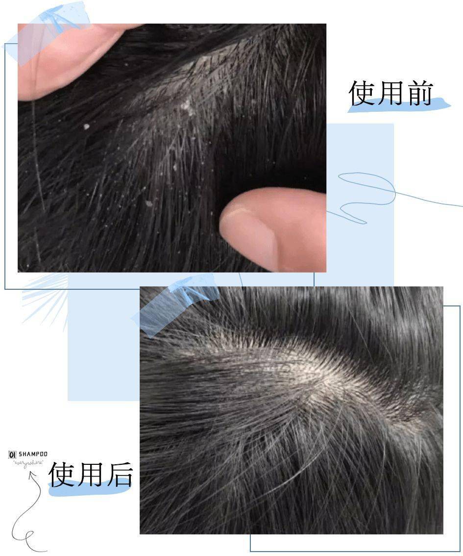克兰|头上抠下的“白泥”，居然不是头皮屑？脱发头油都是因为它？