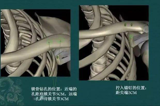 肩锁关节脱位3个步骤9种治疗方法