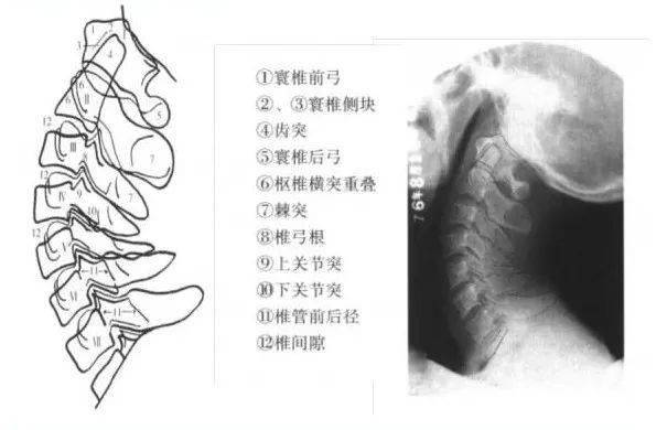 上位颈椎x光片,张口位 1 枢椎之齿突,2 寰枢之外侧块,3 寰枢关节,4
