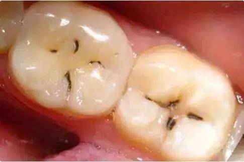 蛀牙的初步症状是肉眼可见的黑线,放任不管便会形成蛀洞.