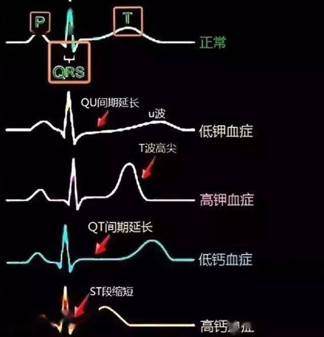 15.电解质紊乱的典型心电图表现