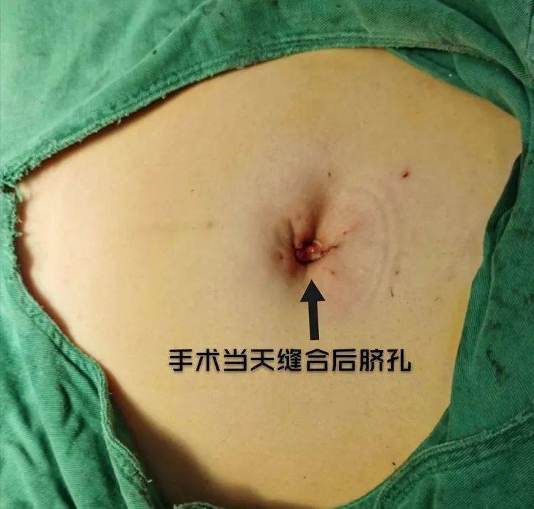 术后,完美隐藏手术疤痕 单孔腹腔镜手术有巨大的临床优势,但其对术者