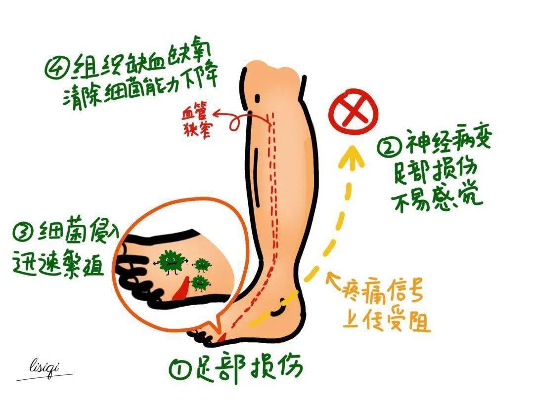 骨折人口_腿骨折图片(2)