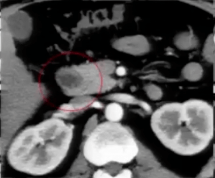 胰腺|看得懂这些腹部CT，主任一定对你刮目相看！