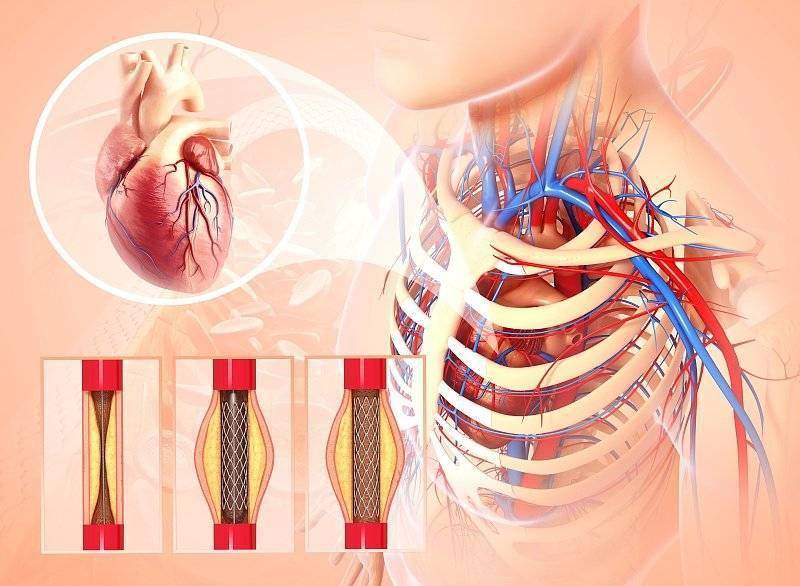 爆降93%,700块的心脏支架动了谁的奶酪?
