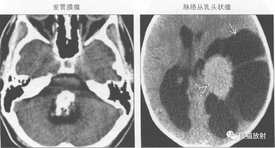 11-07 21:03 订阅 点击查看更多订阅内容> 鉴别诊断 常见 脉络丛生理