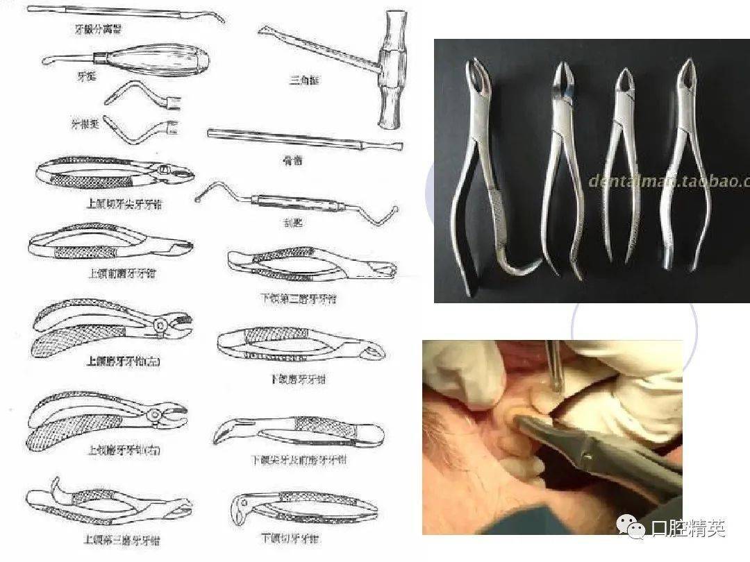 口腔科常用器械图谱结构及功能介绍