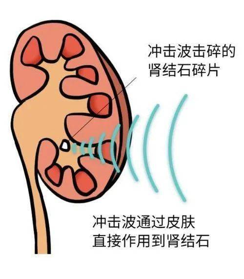 体外冲击波碎石:革命疗法适应症有限