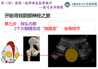 阴部|和（何）亮亮一起学超声技巧系列：超声引导阴部神经阻滞