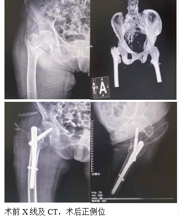 稳定的股骨粗隆间骨折治疗方法 3b100d70a3ac4f6187f116a2b8540254.png