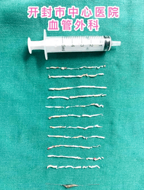 开封市中心医院成功开展血管减容巧克力球囊扩张术治疗下肢动脉硬化