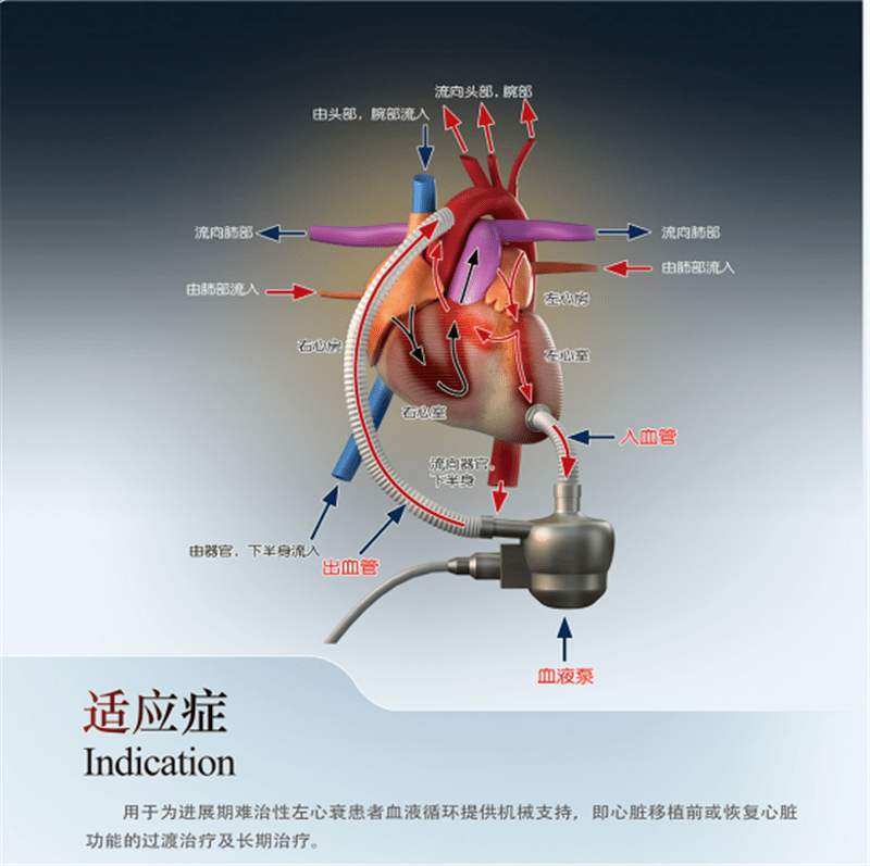 由省人民医院心脏外科中心黄克力和于涛主任主刀,北京阜外心血管病