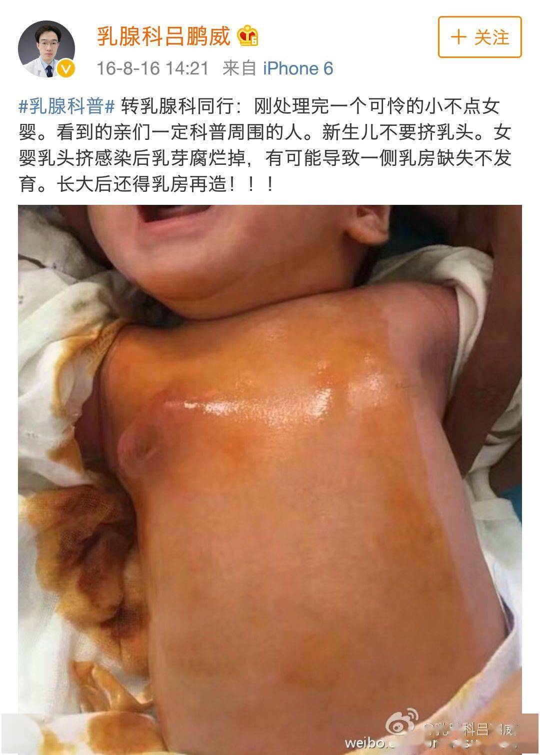 乳腺炎|这件事一定别再做了！8月女婴因「挤乳头」患上乳腺炎