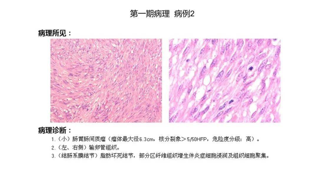 读片|浙江省肿瘤医院放射科读片会（第二期）