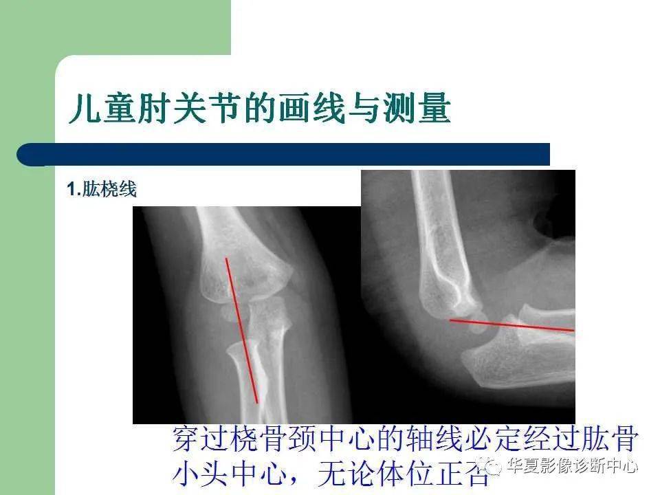 【影像基础】儿童肘关节损伤x线诊断