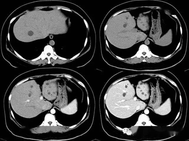 ct显示:肝内多发大小不一的低密度灶.见图4.