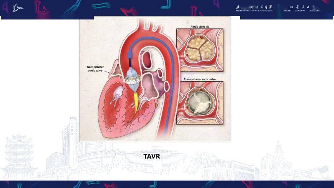 tavr围手术期ct影像学评估