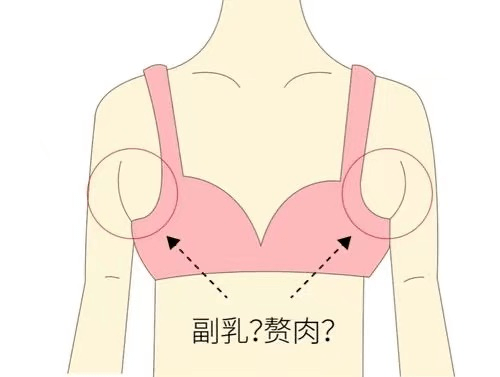 产后副乳多一坨赘肉,影响的只是美观?不!危害可多