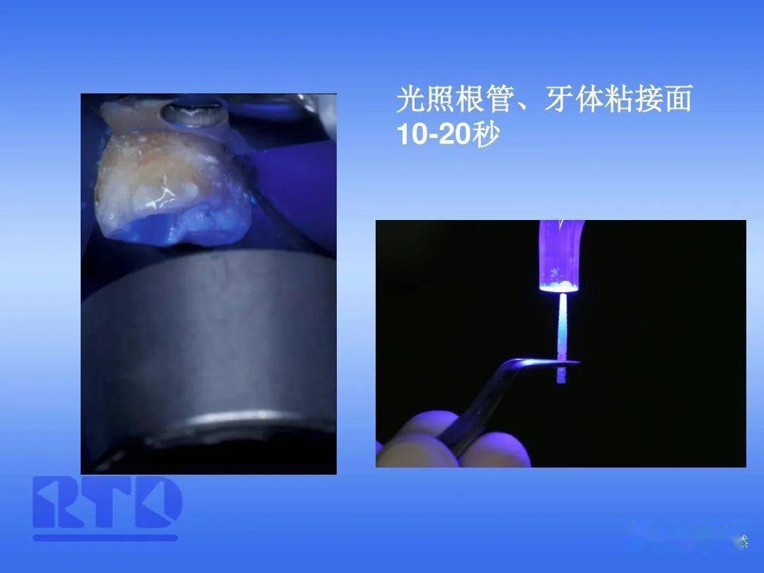 纤维桩技术及其在临床的应用