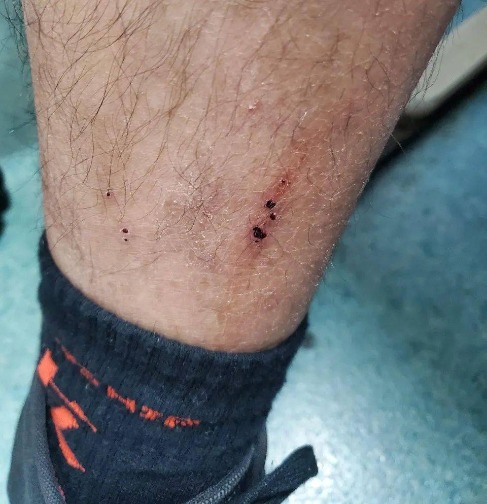 什么是特应性皮炎患者 f747699a3802448dad4cb58ccfba4197.jpeg