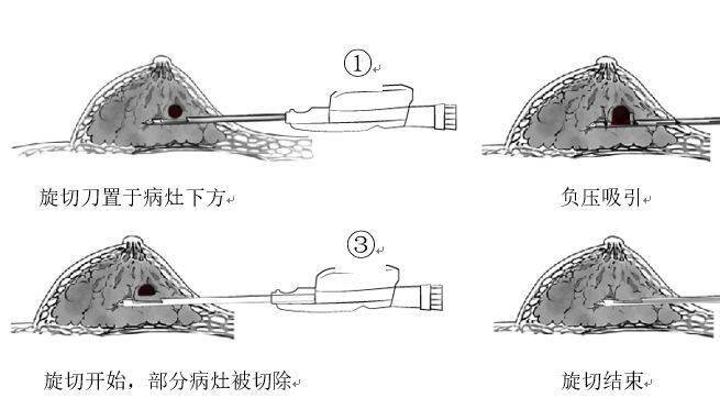 vab乳腺微创旋切(术)活检1微创化是当今外科发展的趋势之一,我院普