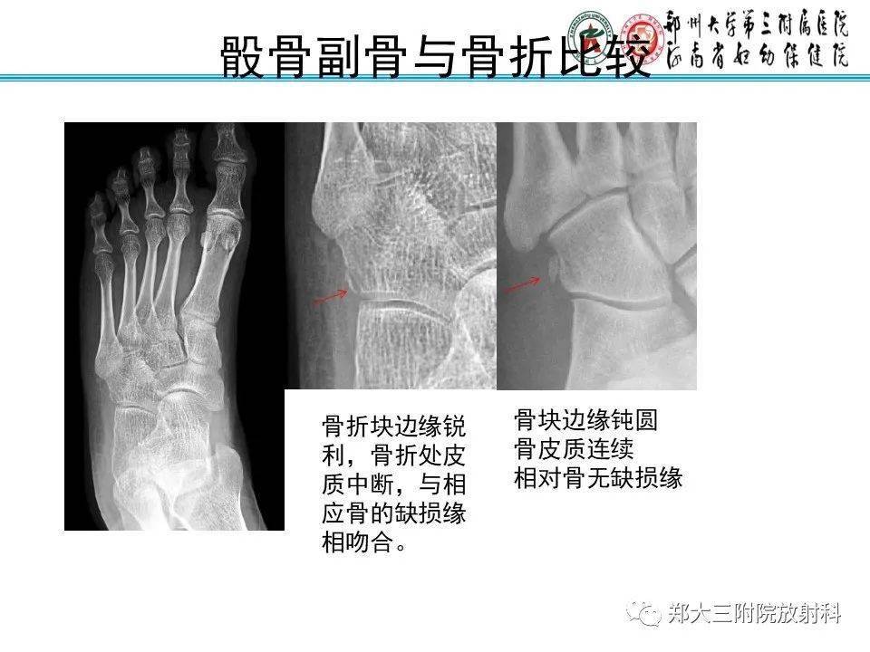 撕脱性骨折的x线诊断及鉴别