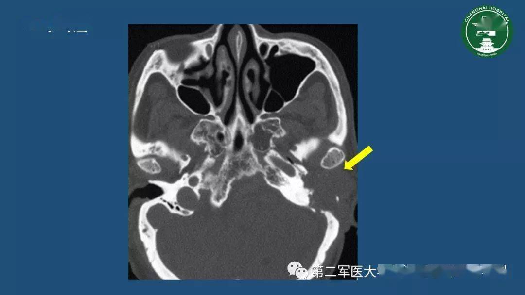 颞骨ct解剖及其常见病变