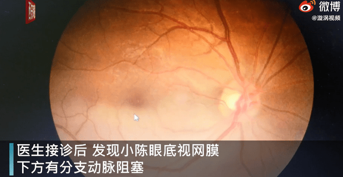 警惕手机依赖，小伙熬夜刷手机引发视网膜脱落的警示