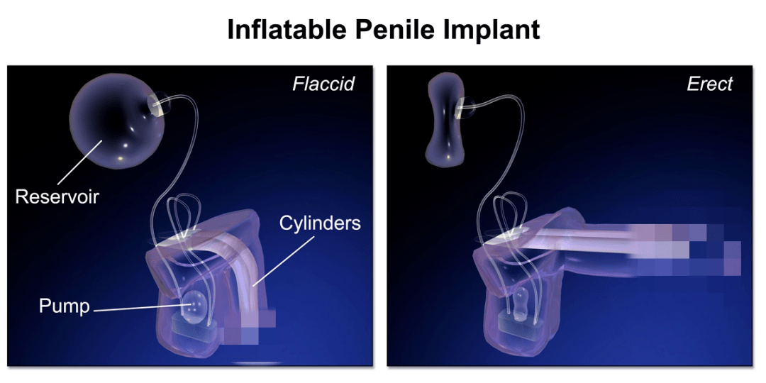 国内首例植入假丁丁按压开关就勃起 搜狐大视野 搜狐新闻
