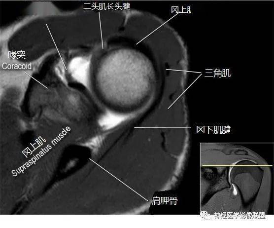 断层解剖 | 肩关节磁共振