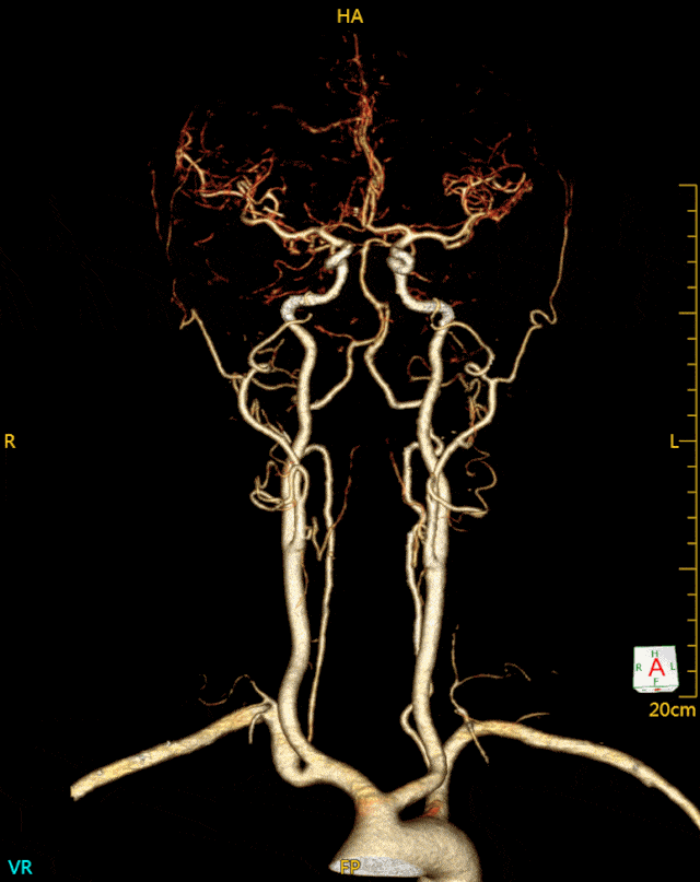 乌拉特前旗人民医院影像中心带你认识头颈部血管cta成像技术