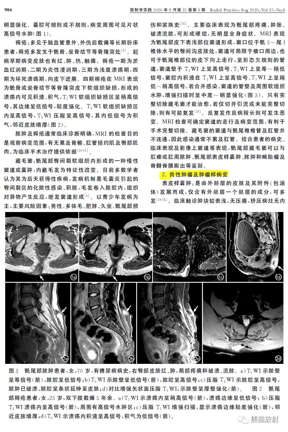 图文讲座丨成人骶尾部皮下病变的mri诊断和分析