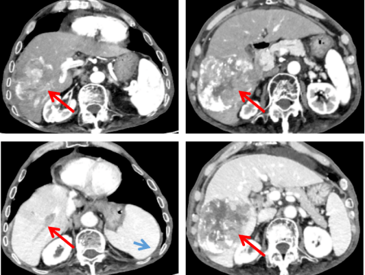 全腹增强ct(2020-07-02):肝硬化,肝癌破裂介入术后改变,病灶仍有活性