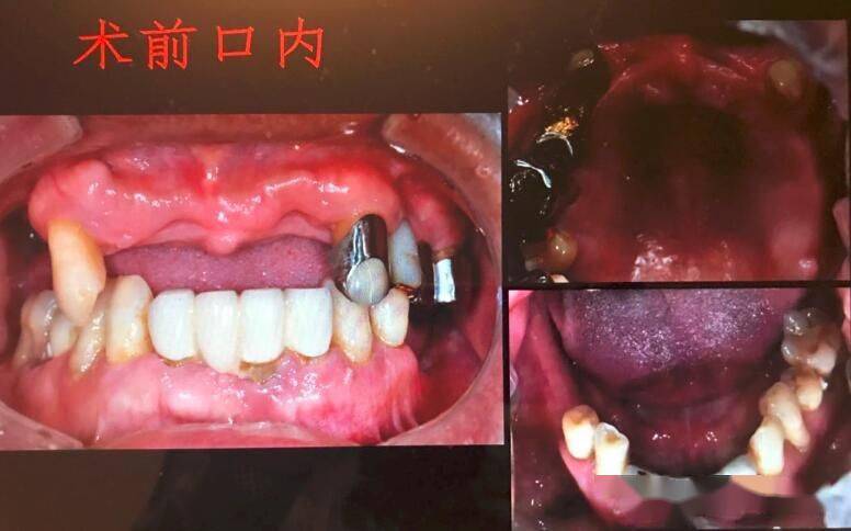 全口无牙颌种植病例-高恩峰博士