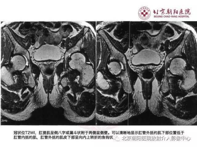 图解肛瘘的解剖和影像诊断