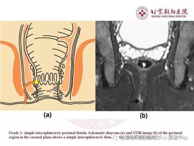 图解肛瘘的解剖和影像诊断