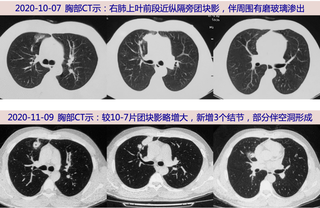 探案丨青年男性胸痛三月,pet/ct显示肺结节和淋巴肿